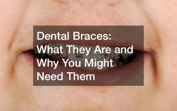 Dental Braces: What They Are and Why You Might Need Them